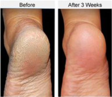 Electric Foot Callus Remover – Rechargeable Automatic Pedicure Grinder for Smooth, Soft, Healthy Feet